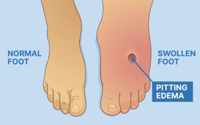 Edema VS Lymphedema