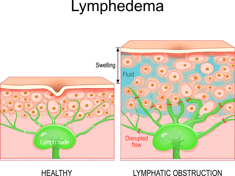 Lymphatic obstruction in lymphedema
